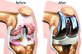 استبدال مفصل الركبة