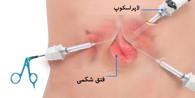 فتق البطن منظار البطن