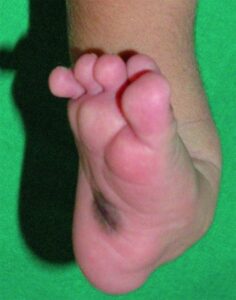 Talipes calcaneovalgus