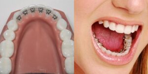 Orthodontic