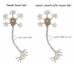 التصلب العصبي