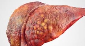 Fatty Liver