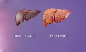 Fatty Liver