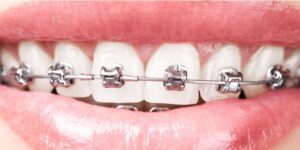 Orthodontic