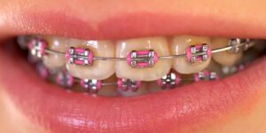 Orthodontic